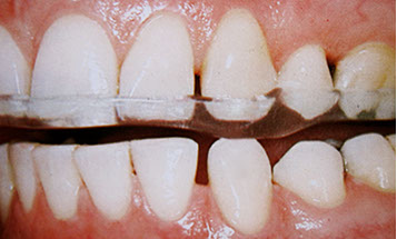 Zahnarztpraxis Dr. Isabel Selmair - München, Schwabing / Schienentherapie, Zähneknirschen