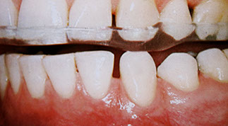 Zahnarztpraxis Dr. Isabel Selmair - München, Schwabing / Schienentherapie, Zähneknirschen