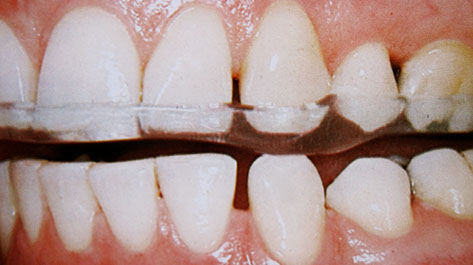 Zahnarztpraxis Dr. Isabel Selmair - München, Schwabing / Schienentherapie, Zähneknirschen