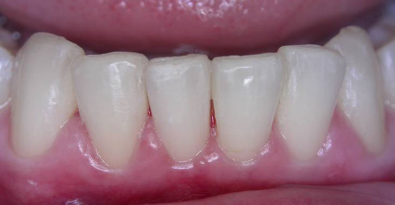 Zahnarztpraxis Dr. Isabel Selmair - München, Schwabing / Schienentherapie, Aligner Therapie