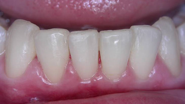 Zahnarztpraxis Dr. Isabel Selmair - München, Schwabing / Schienentherapie, Aligner Therapie