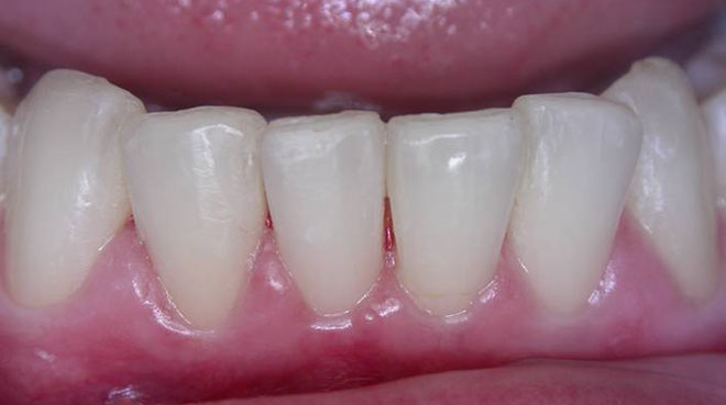 Zahnarztpraxis Dr. Isabel Selmair - München, Schwabing / Schienentherapie, Aligner Therapie