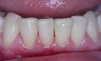 Zahnarztpraxis Dr. Isabel Selmair - München, Schwabing / Schienentherapie, Aligner Therapie