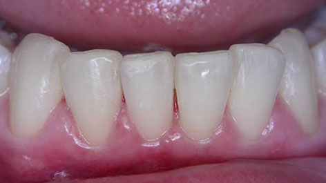 Zahnarztpraxis Dr. Isabel Selmair - München, Schwabing / Schienentherapie, Aligner Therapie