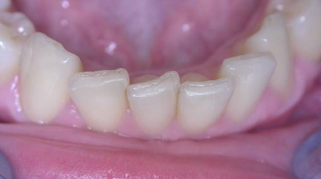 Zahnarztpraxis Dr. Isabel Selmair - München, Schwabing / Schienentherapie, Aligner Therapie