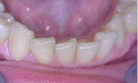 Zahnarztpraxis Dr. Isabel Selmair - München, Schwabing / Schienentherapie, Aligner Therapie