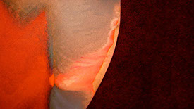 Zahnarztpraxis Dr. Isabel Selmair - München, Schwabing / Minimalinvasive Füllungstechniken, Karies