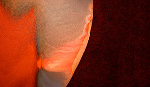 Zahnarztpraxis Dr. Isabel Selmair - München, Schwabing / Minimalinvasive Füllungstechniken, Karies