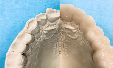 Zahnarztpraxis Dr. Isabel Selmair - München, Schwabing / Schienentherapie, Schienen