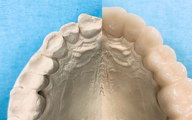 Zahnarztpraxis Dr. Isabel Selmair - München, Schwabing / Schienentherapie, Schienen
