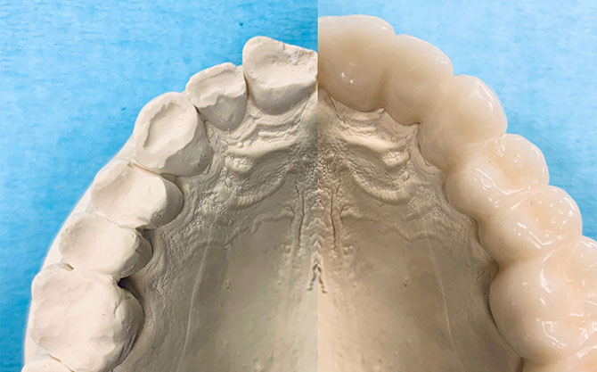 Zahnarztpraxis Dr. Isabel Selmair - München, Schwabing / Schienentherapie, Schienen
