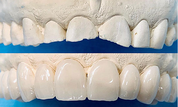 Zahnarztpraxis Dr. Isabel Selmair - München, Schwabing / Schienentherapie, Schienen