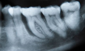Zahnarztpraxis Dr. Isabel Selmair - München, Schwabing / Parodontitisbehandlung