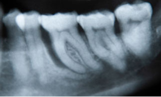 Zahnarztpraxis Dr. Isabel Selmair - München, Schwabing / Parodontitisbehandlung