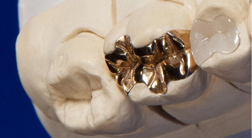 Zahnarztpraxis Dr. Isabel Selmair - München, Schwabing / Füllungen, Inlays