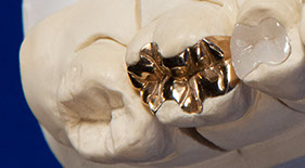 Zahnarztpraxis Dr. Isabel Selmair - München, Schwabing / Füllungen, Inlays