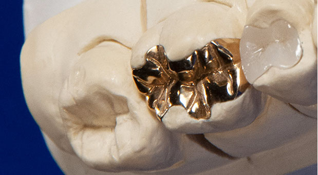 Zahnarztpraxis Dr. Isabel Selmair - München, Schwabing / Füllungen, Inlays