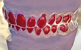 Zahnarztpraxis Dr. Isabel Selmair - München, Schwabing / Ästhetische Rekonstruktionen, Bleaching