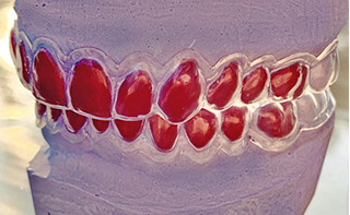 Zahnarztpraxis Dr. Isabel Selmair - München, Schwabing / Ästhetische Rekonstruktionen, Bleaching