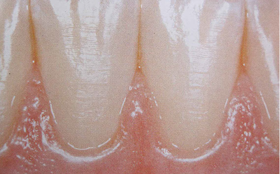 Zahnarztpraxis Dr. Isabel Selmair - München, Schwabing / Parodontitisbehandlung