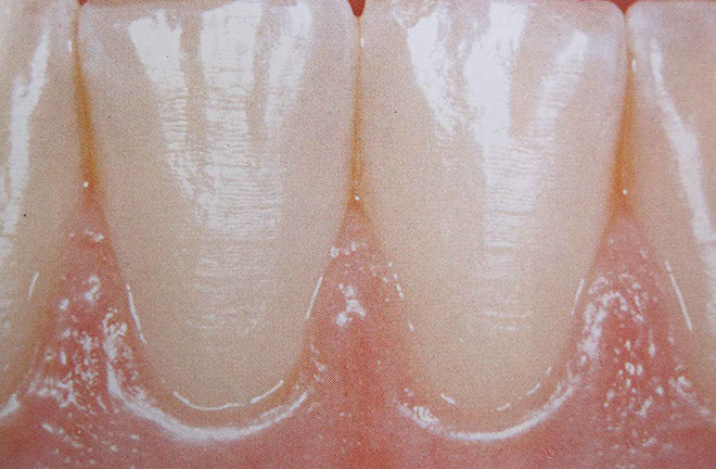 Zahnarztpraxis Dr. Isabel Selmair - München, Schwabing / Parodontitisbehandlung