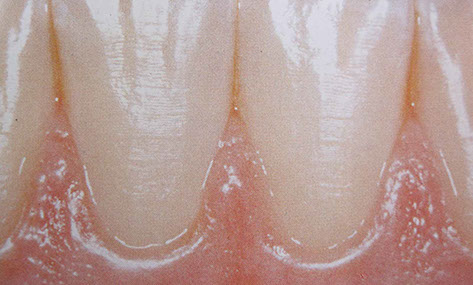 Zahnarztpraxis Dr. Isabel Selmair - München, Schwabing / Parodontitisbehandlung