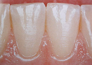 Zahnarztpraxis Dr. Isabel Selmair - München, Schwabing / Parodontitisbehandlung