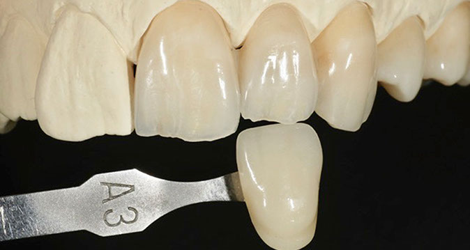 Zahnarztpraxis Dr. Isabel Selmair - München, Schwabing / Zahnersatz, Kronen Brücken