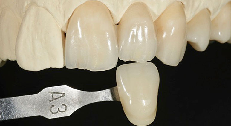 Zahnarztpraxis Dr. Isabel Selmair - München, Schwabing / Zahnersatz, Kronen Brücken