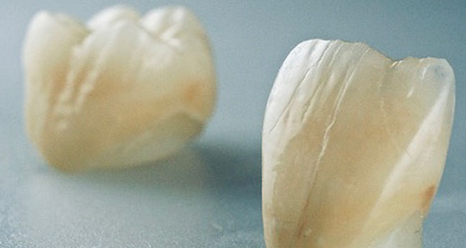 Zahnarztpraxis Dr. Isabel Selmair - München, Schwabing / Zahnersatz, Kronen Brücken