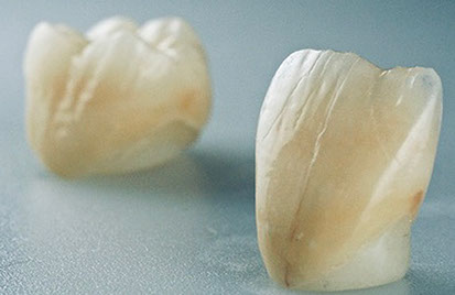 Zahnarztpraxis Dr. Isabel Selmair - München, Schwabing / Zahnersatz, Kronen Brücken