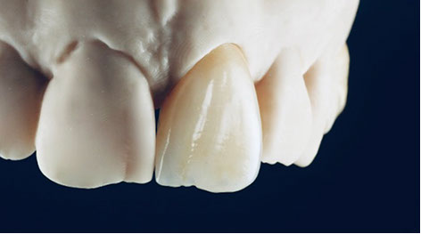 Zahnarztpraxis Dr. Isabel Selmair - München, Schwabing / Zahnersatz, Kronen Brücken