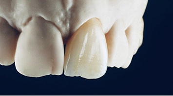 Zahnarztpraxis Dr. Isabel Selmair - München, Schwabing / Zahnersatz, Kronen Brücken