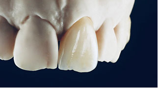 Zahnarztpraxis Dr. Isabel Selmair - München, Schwabing / Zahnersatz, Kronen Brücken