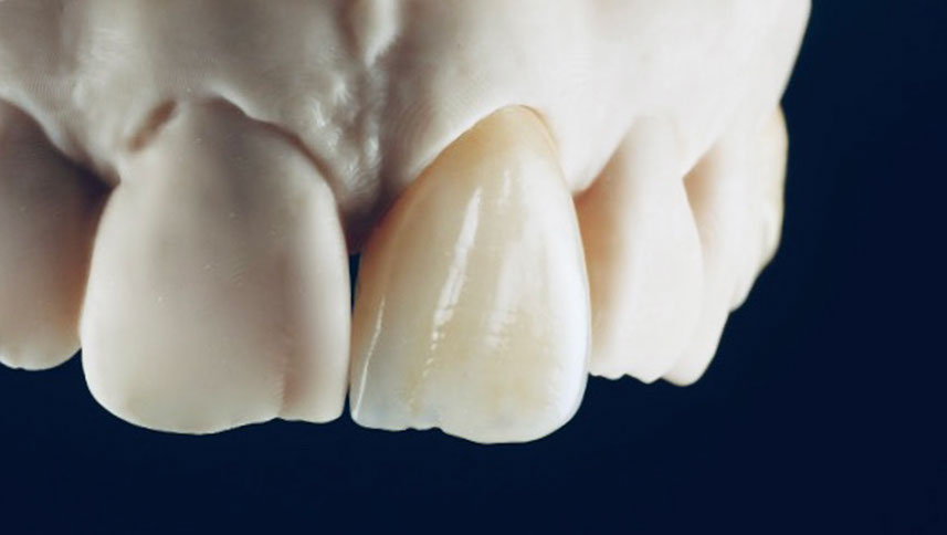 Zahnarztpraxis Dr. Isabel Selmair - München, Schwabing / Zahnersatz, Kronen Brücken