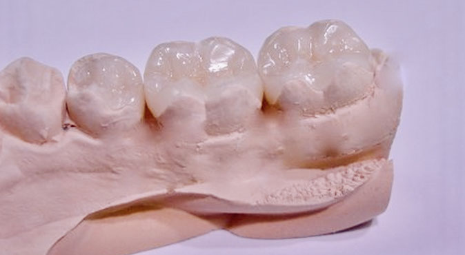 Zahnarztpraxis Dr. Isabel Selmair - München, Schwabing / Füllungen, Inlays