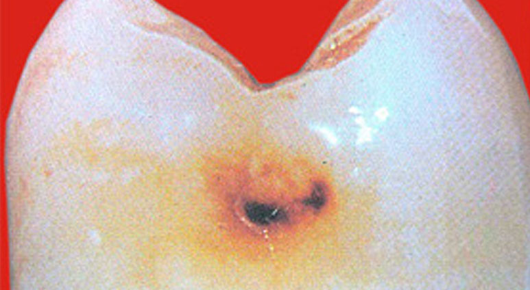 Zahnarztpraxis Dr. Isabel Selmair - München, Schwabing / Minimalinvasive Füllungstechniken, Karies