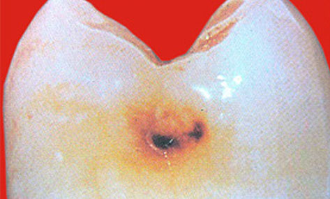 Zahnarztpraxis Dr. Isabel Selmair - München, Schwabing / Minimalinvasive Füllungstechniken, Karies