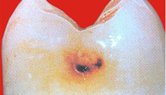 Zahnarztpraxis Dr. Isabel Selmair - München, Schwabing / Minimalinvasive Füllungstechniken, Karies