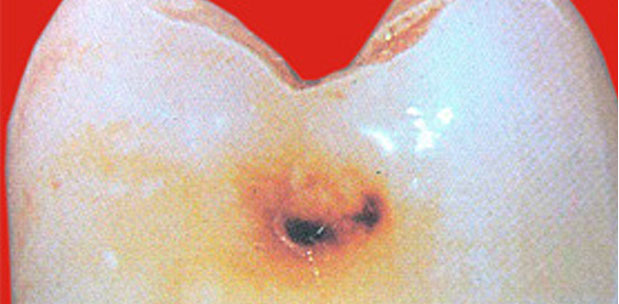 Zahnarztpraxis Dr. Isabel Selmair - München, Schwabing / Minimalinvasive Füllungstechniken, Karies