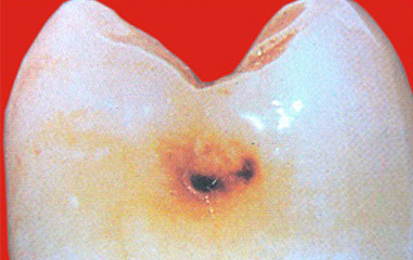 Zahnarztpraxis Dr. Isabel Selmair - München, Schwabing / Minimalinvasive Füllungstechniken, Karies