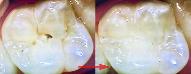 Zahnarztpraxis Dr. Isabel Selmair - München, Schwabing / Minimalinvasive Füllungstechniken, Korrekturen im Kunstoff