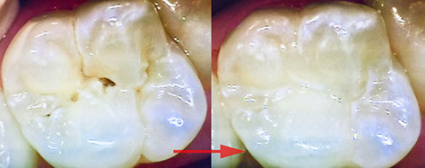 Zahnarztpraxis Dr. Isabel Selmair - München, Schwabing / Minimalinvasive Füllungstechniken, Korrekturen im Kunstoff