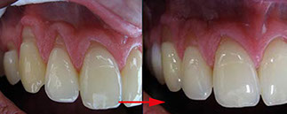 Zahnarztpraxis Dr. Isabel Selmair - München, Schwabing / Minimalinvasive Füllungstechniken, Korrekturen im Kunstoff