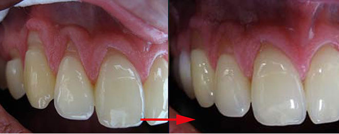 Zahnarztpraxis Dr. Isabel Selmair - München, Schwabing / Minimalinvasive Füllungstechniken, Korrekturen im Kunstoff