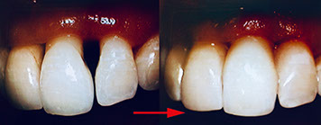Zahnarztpraxis Dr. Isabel Selmair - München, Schwabing / Minimalinvasive Füllungstechniken, Korrekturen im Kunstoff