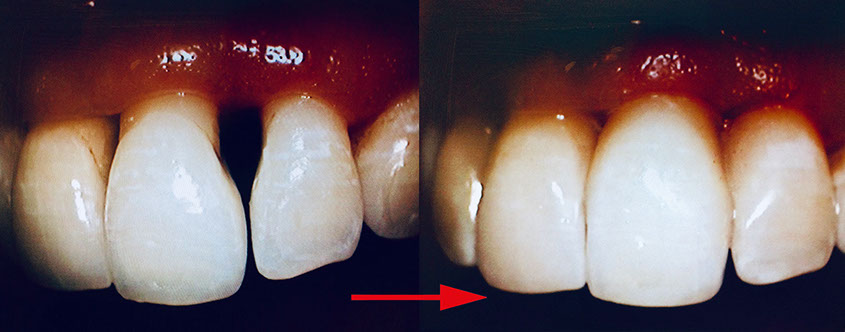 Zahnarztpraxis Dr. Isabel Selmair - München, Schwabing / Minimalinvasive Füllungstechniken, Korrekturen im Kunstoff