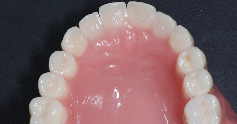 Zahnarztpraxis Dr. Isabel Selmair - München, Schwabing / Zahnersatz, Totalprothese