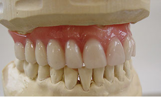 Zahnarztpraxis Dr. Isabel Selmair - München, Schwabing / Zahnersatz, Totalprothese