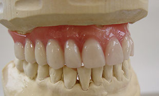 Zahnarztpraxis Dr. Isabel Selmair - München, Schwabing / Zahnersatz, Totalprothese